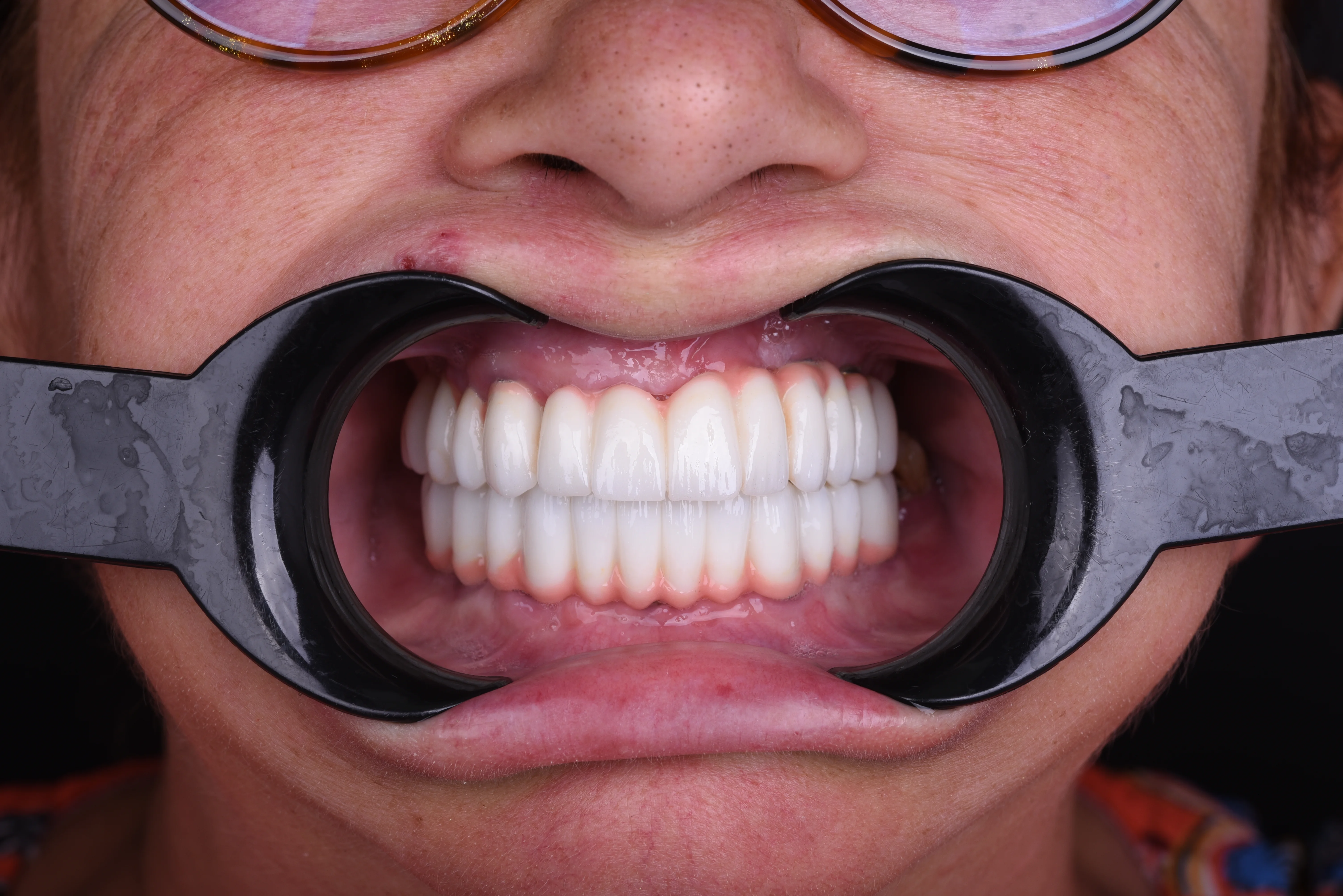 Türkiye'de Tam Ağız Restorasyonu: Kendinize Olan Güveninizi Geri Kazanın