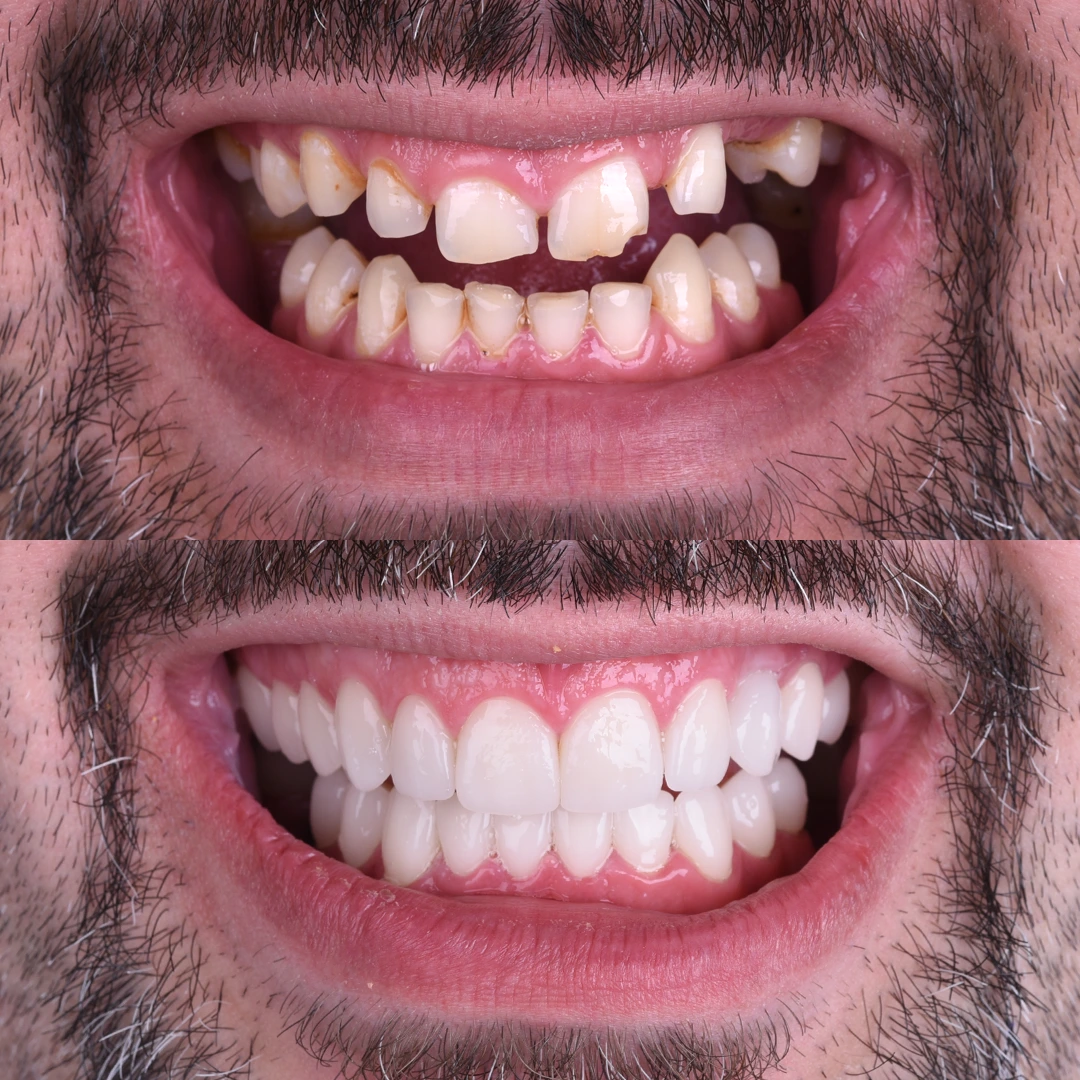 Hollywood Smile Nedir ve Görünümünüzü Nasıl Dönüştürebilir?