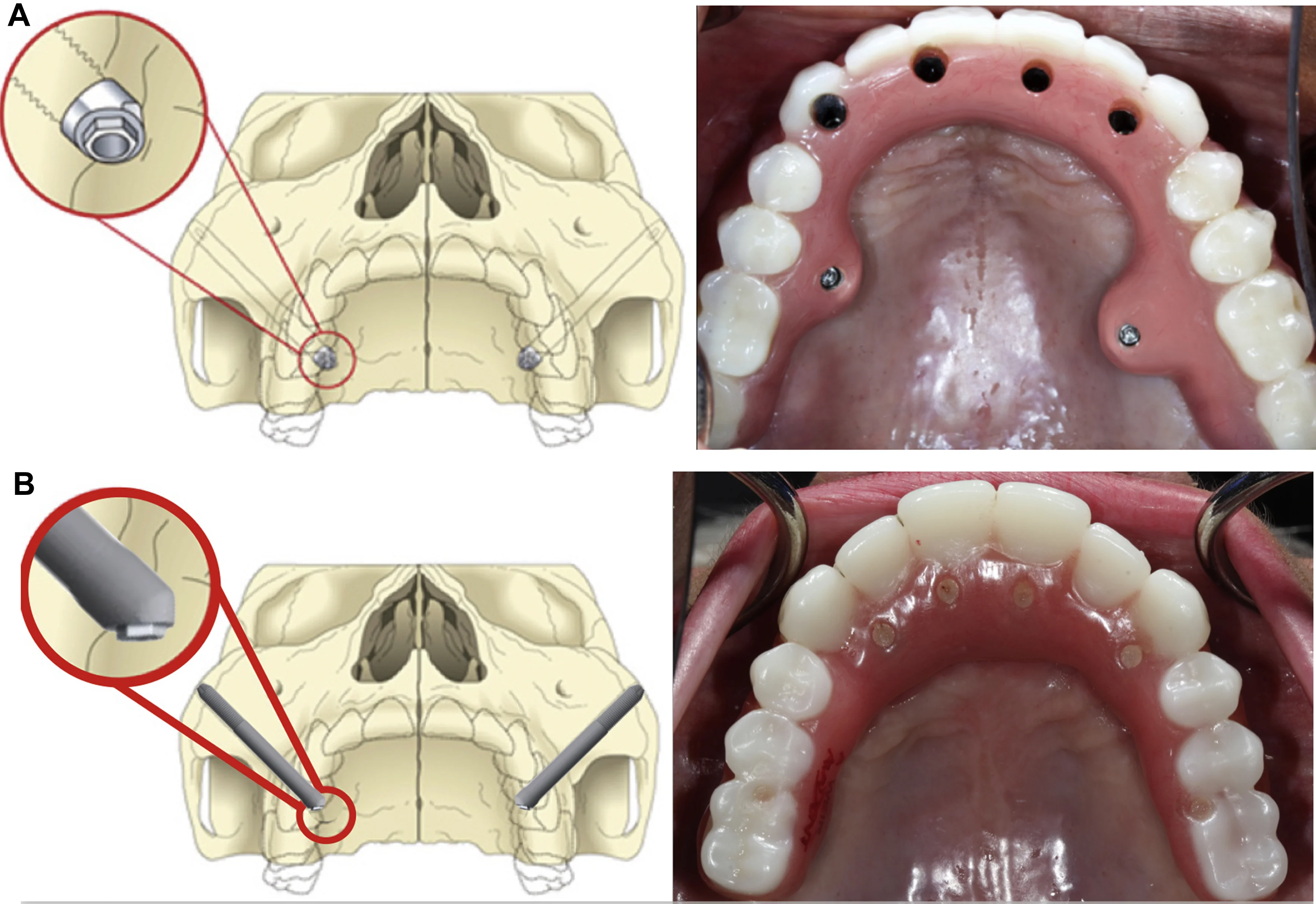 Zygomatic İmplantlar: Türkiye'de 